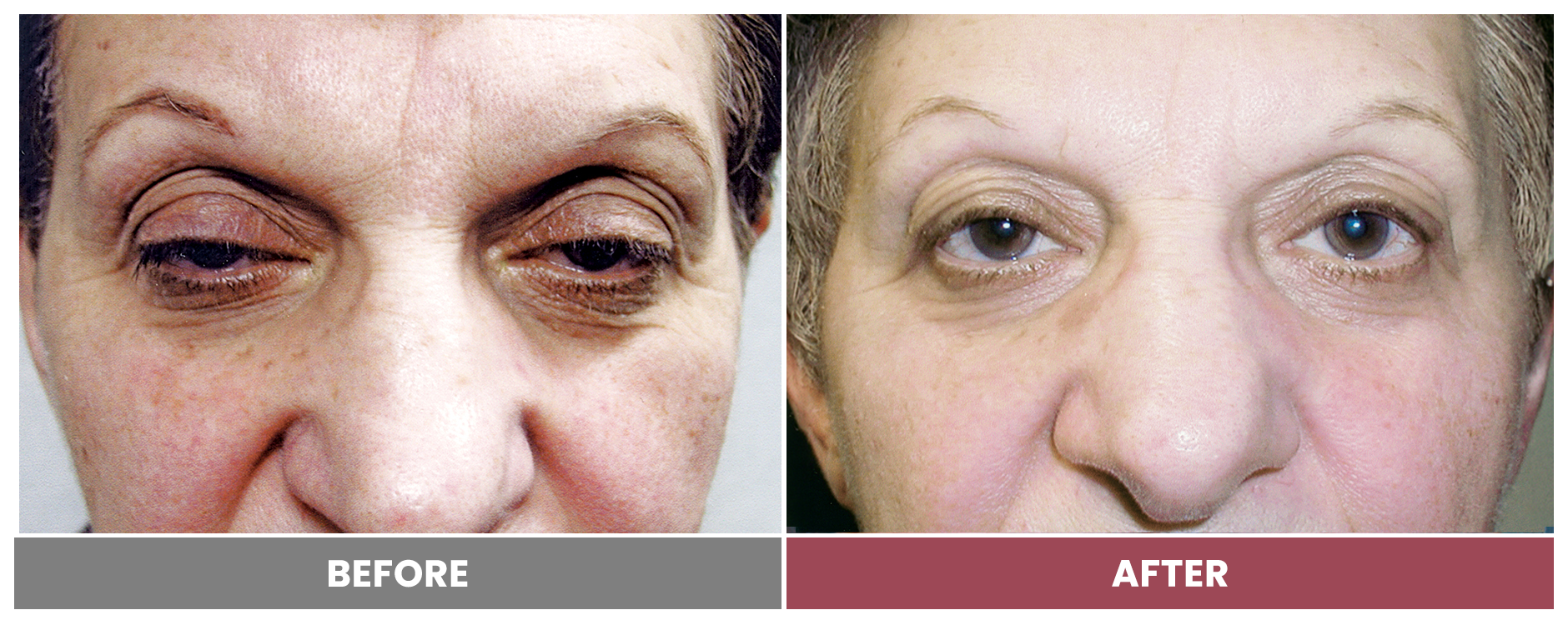PTOSIS REPAIR - Case 5